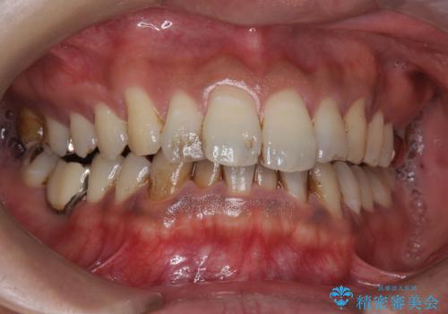 タバコによるヤニ、着色、歯の汚れをPMTC(60分コース)で除去。の症例 治療前