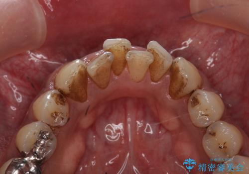 タバコによるヤニ、着色、歯の汚れをPMTC(60分コース)で除去。の治療前