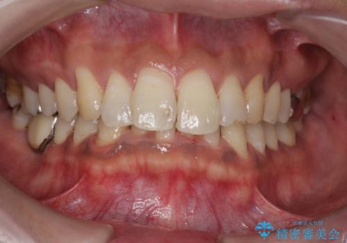 タバコによるヤニ、着色、歯の汚れをPMTC(60分コース)で除去。の症例 治療後