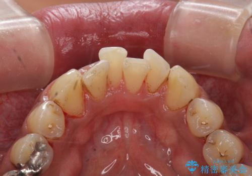 タバコによるヤニ、着色、歯の汚れをPMTC(60分コース)で除去。の治療後