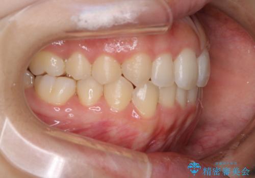 オープンバイト(開咬)を非抜歯インビザラインで治すの治療後