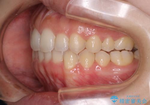 オープンバイト(開咬)を非抜歯インビザラインで治すの治療後