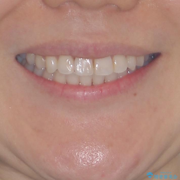 長年気にしていた前歯 インビザラインで目立たず改善の治療後(顔貌)