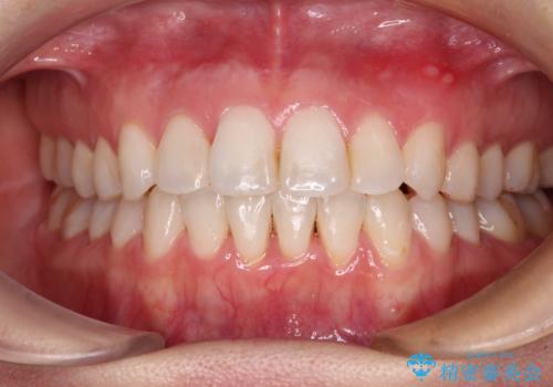 長年気にしていた前歯 インビザラインで目立たず改善の治療後