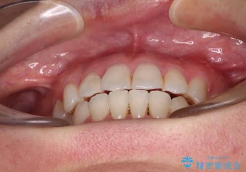 長年気にしていた前歯 インビザラインで目立たず改善の治療後