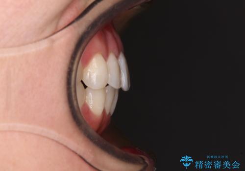 長年気にしていた前歯 インビザラインで目立たず改善の治療後