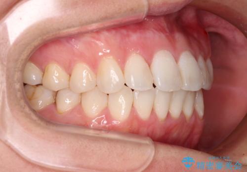 長年気にしていた前歯 インビザラインで目立たず改善の治療後