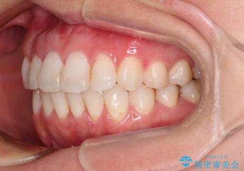 長年気にしていた前歯 インビザラインで目立たず改善の治療後