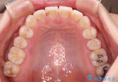 長年気にしていた前歯 インビザラインで目立たず改善の治療後