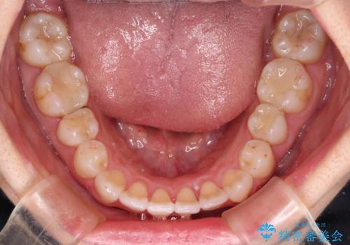 長年気にしていた前歯 インビザラインで目立たず改善の治療後