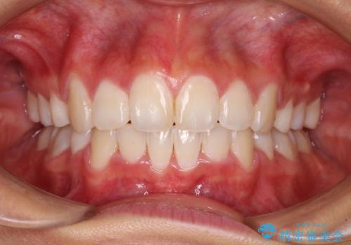 口元の突出感を改善　2年弱での抜歯矯正の症例 治療後