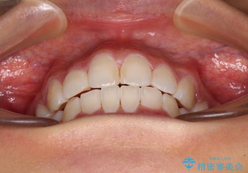 口元の突出感を改善 2年弱での抜歯矯正の治療後