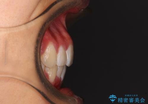 口元の突出感を改善 2年弱での抜歯矯正の治療後