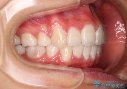 口元の突出感を改善 2年弱での抜歯矯正の治療後