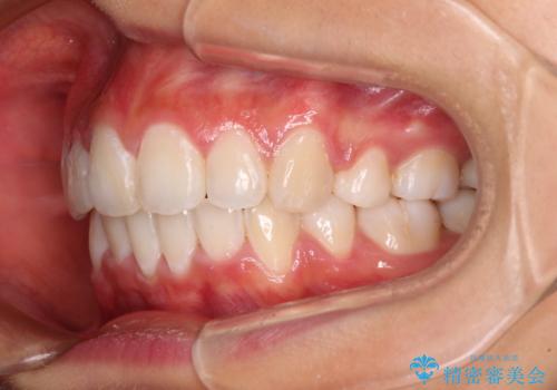口元の突出感を改善 2年弱での抜歯矯正の治療後