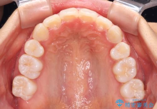 口元の突出感を改善 2年弱での抜歯矯正の治療後
