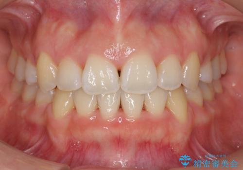 美容整形よりも、自然な美しさを。口元は大事です。の治療後