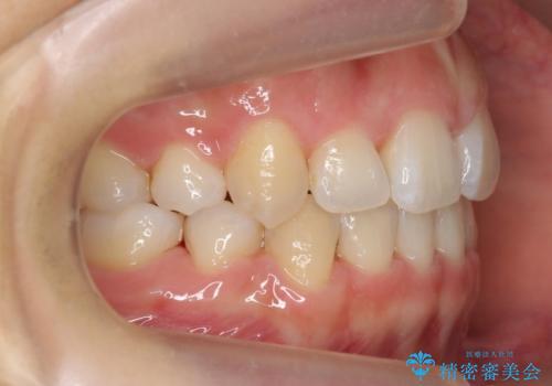 美容整形よりも、自然な美しさを。口元は大事です。の治療後