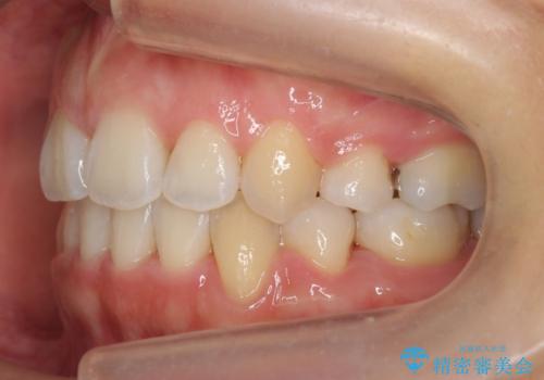 美容整形よりも、自然な美しさを。口元は大事です。の治療後