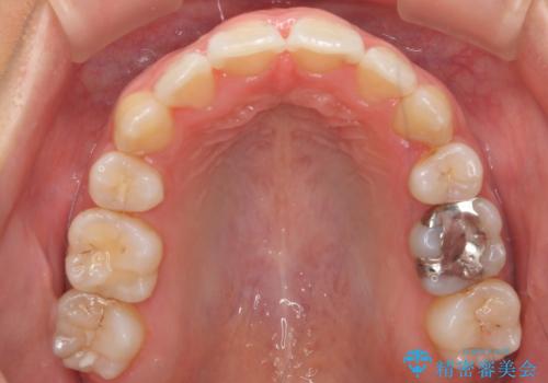 美容整形よりも、自然な美しさを。口元は大事です。の治療後