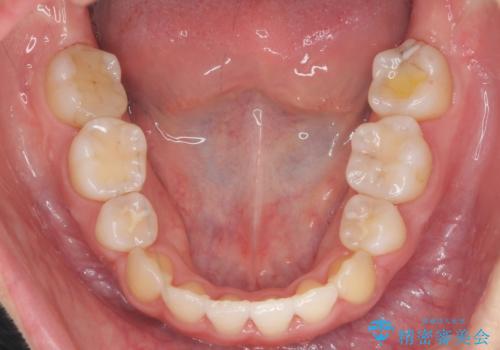 美容整形よりも、自然な美しさを。口元は大事です。の治療後