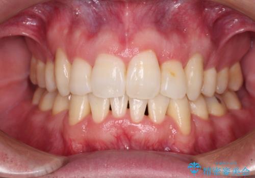 ものが挟まる 著しい叢生を解消 ワイヤー装置による抜歯矯正の症例 治療後