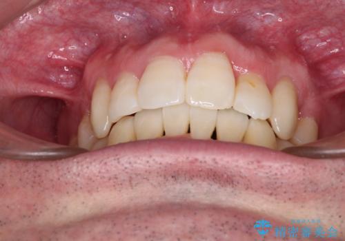 ものが挟まる 著しい叢生を解消 ワイヤー装置による抜歯矯正の治療後
