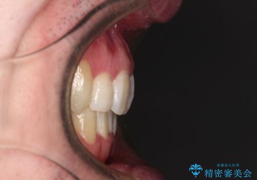 ものが挟まる 著しい叢生を解消 ワイヤー装置による抜歯矯正の治療後