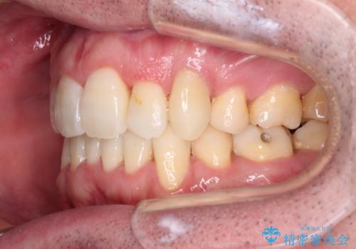 ものが挟まる　著しい叢生を解消　ワイヤー装置による抜歯矯正の治療後