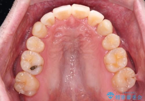 ものが挟まる 著しい叢生を解消 ワイヤー装置による抜歯矯正の治療後