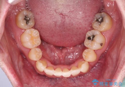 ものが挟まる 著しい叢生を解消 ワイヤー装置による抜歯矯正の治療後
