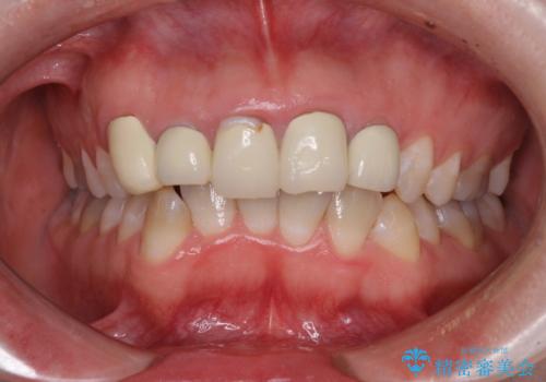 不揃いな前歯のセラミックが気になる オールセラミッククラウンによる補綴治療の治療前