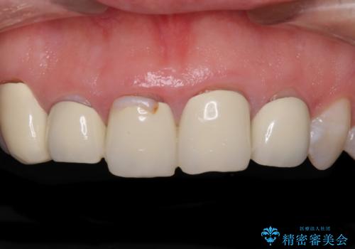 不揃いな前歯のセラミックが気になる オールセラミッククラウンによる補綴治療の治療前