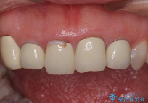 不揃いな前歯のセラミックが気になる オールセラミッククラウンによる補綴治療の治療前