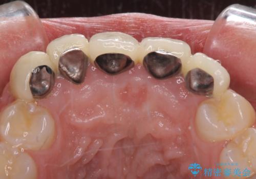 不揃いな前歯のセラミックが気になる オールセラミッククラウンによる補綴治療の治療前