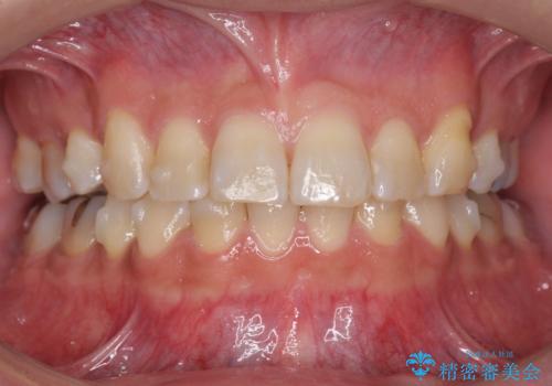 前歯だけ治したい インビザライン・ライト 30代男性の治療中