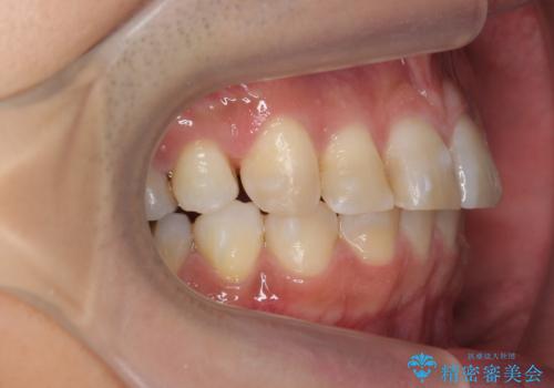 前歯だけ治したい インビザライン・ライト 30代男性の治療中