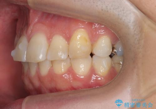 前歯だけ治したい インビザライン・ライト 30代男性の治療中