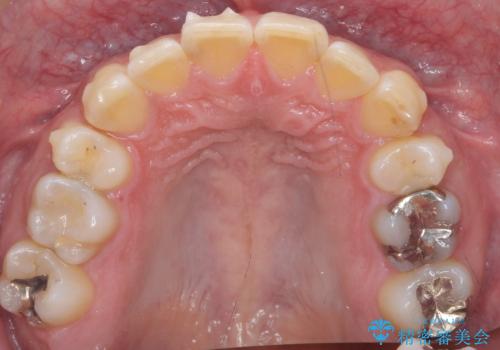 前歯だけ治したい インビザライン・ライト 30代男性の治療中