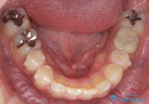 前歯だけ治したい インビザライン・ライト 30代男性の治療中