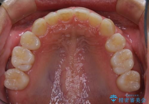 途中で終わってしまったワイヤー治療もインビザラインでの治療後