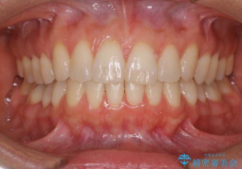 上下の真ん中を合わせて横顔シルエットも改善の症例 治療後