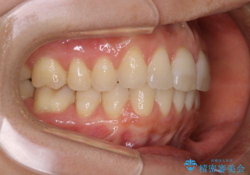 上下の真ん中を合わせて横顔シルエットも改善の治療後