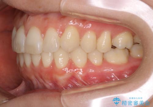 上下の真ん中を合わせて横顔シルエットも改善の治療後