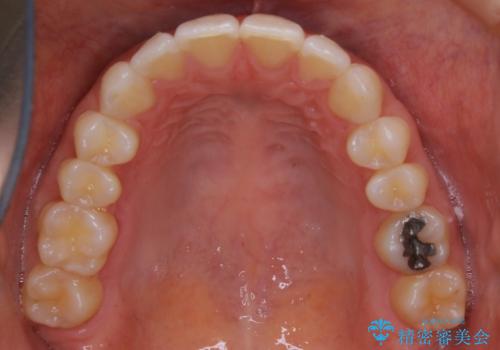 上下の真ん中を合わせて横顔シルエットも改善の治療後