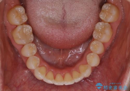 上下の真ん中を合わせて横顔シルエットも改善の治療後