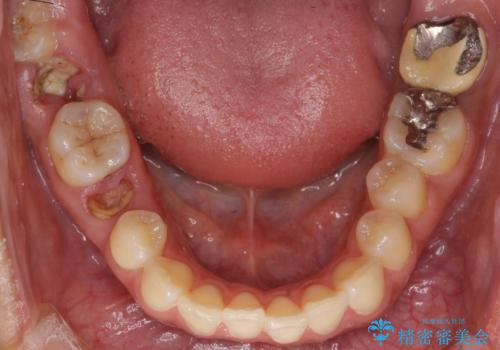 歯が折れた 低予算でオールセラミックのブリッジ 20代女性の治療前