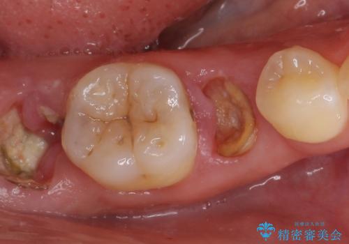 歯が折れた 低予算でオールセラミックのブリッジ 20代女性の治療前