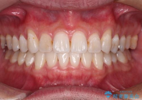 【モニター】 インビザライン・ライトによる軽微叢生の矯正治療の症例 治療後