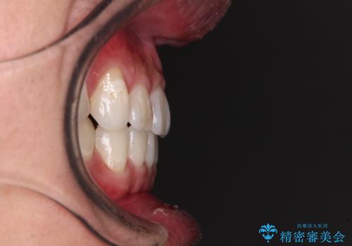【モニター】 インビザライン・ライトによる軽微叢生の矯正治療の治療後